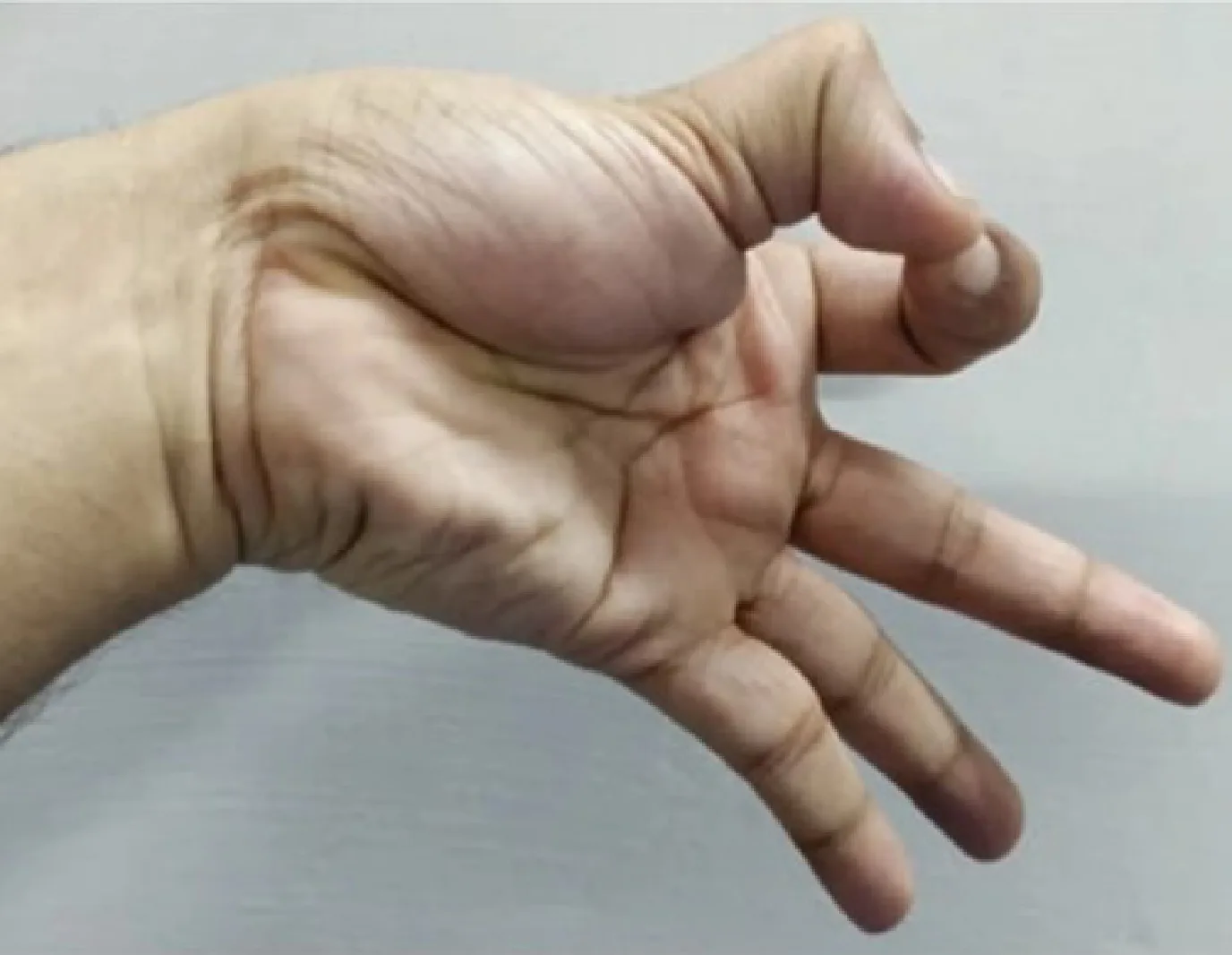 114 第1次 骨科疾病物理治療學 第 42 題 題目圖片